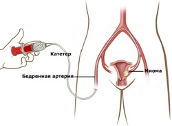 Лікування міоми матки