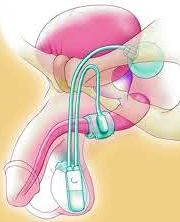 Tratamentul incontinenței urinare la bărbați - implantarea unui sfincter artificial