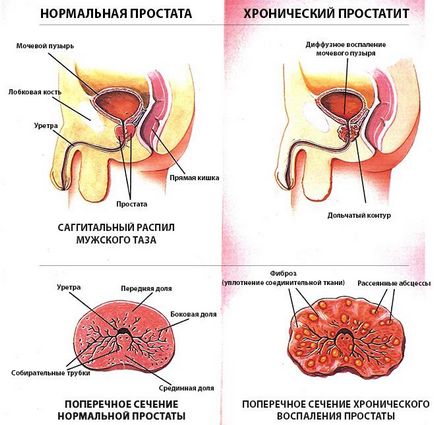 Лікування простатиту в Москві ціни, методи лікування