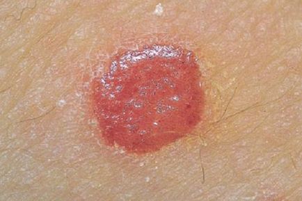 Psoriasis kezelés otthoni kenőcsök és más eszközök Vanny