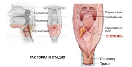 Tratamentul metodei moderne a cancerului laringian, gâtul