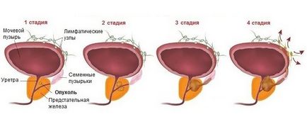 Tratamentul cancerului de prostată este operațional și fără intervenție chirurgicală