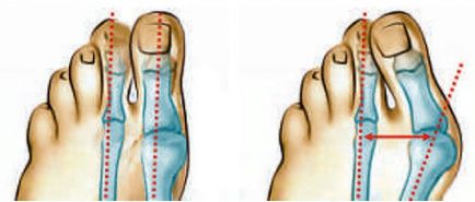 Tratamentul deformărilor valgusului piciorului în clinica lazată; tratamentul eficient al oaselor și al conurilor