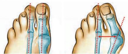 Лікування вальгусной деформації стопи в лазмед клініці; ефективне лікування кісточок і шишок на