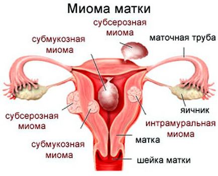 Leiomyomul uterului ce este, intramural și submucos