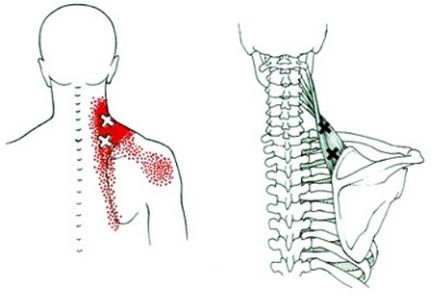 Sindromul spate-rib - simptome și tratament