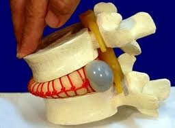 Малоінвазивна хірургія міжхребцевих гриж в москві