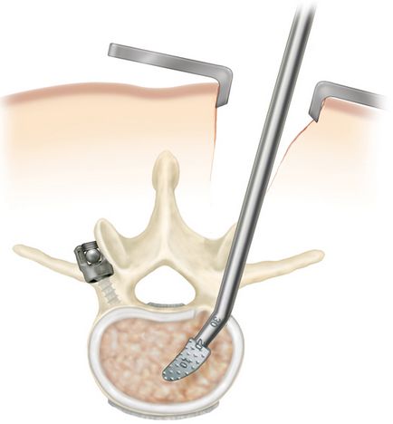 Operație chirurgicală minimă invazivă a coloanei vertebrale