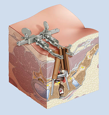 Operație chirurgicală minimă invazivă a coloanei vertebrale