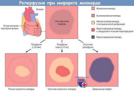 Mecanismele de dezvoltare (patofiziologie) a reperfuziei infarctului miocardic