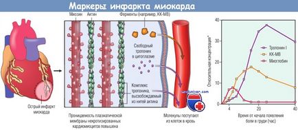 Mecanismele de dezvoltare (patofiziologie) a reperfuziei infarctului miocardic