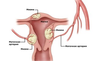 Myomul simptomelor uterine, prevenirea, un program de tratament complementar de la medicul Nonna,