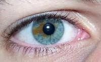 Tudok megszabadulni heterochromia