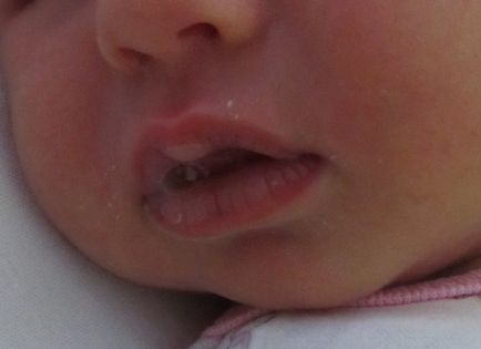 Мозоль на губі у новонародженого верхньої або нижньої, причини виникнення у немовлят і можливі