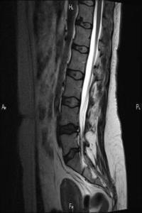 MRI szakrális gerinc Moszkva MRI a keresztcsont