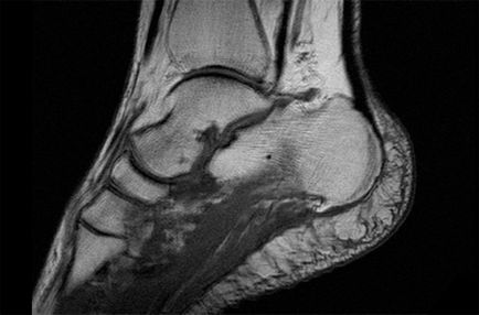 MRI a láb a diagnózis sarokcsontsarkantyú