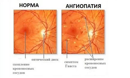 Наскільки небезпечна ангіопатія сітківки ока при вагітності