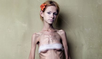 Anorexia nervoasă