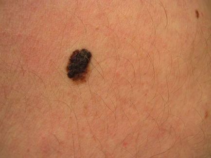 Nevus Clarke cauze atipice ale apariției, forme, metode de tratament