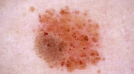 Nevus Clarke cauze atipice ale apariției, forme, metode de tratament