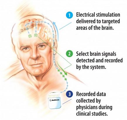 Áttekintés a modern orvosi implantátumok, szórakoztató Robotics (neurostimulator) Áttekintés a modern orvosi implantátumok, szórakoztató Robotics