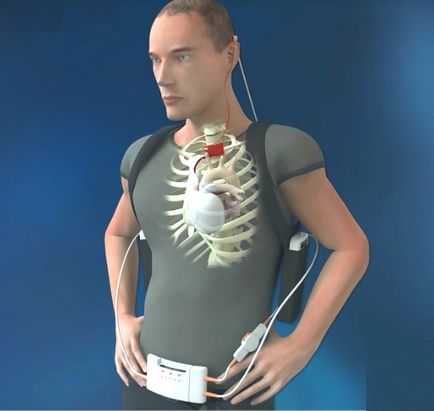 Огляд сучасних медичних імплантів, цікава робототехніка