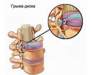 Chirurgie pentru a elimina hernia coloanei vertebrale