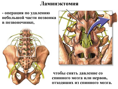 Chirurgie pentru a elimina hernia coloanei vertebrale