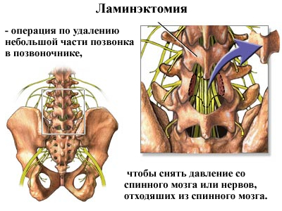 Операція з видалення грижі хребта