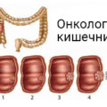 Simptomele tumorilor intestinale, diagnosticul, tratamentul