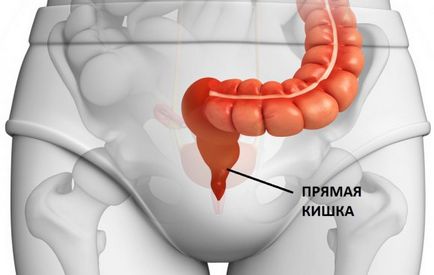 Simptomele tumorilor intestinale, diagnosticul, tratamentul