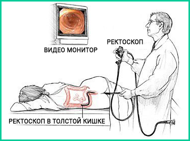 Пухлина кишечника симптоматика, діагностика, лікування