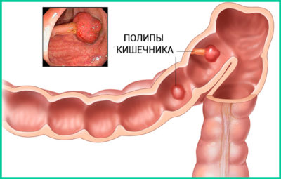 Пухлина кишечника симптоматика, діагностика, лікування