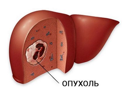 Simptomele tumorilor intestinale, diagnosticul, tratamentul