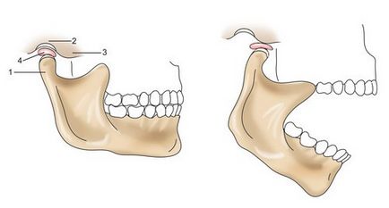 Osteoartrita articulației temporomandibulare - etiologie, clasificare, semne și metode de tratament