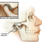 Tratamentul osteoartritei în articulația temporomandibulară