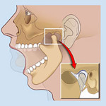 TMJ osteoarthritis kezelésére állkapocsízület