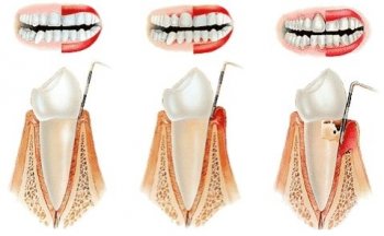 A periodontitis tünetei és kezelése, fotók