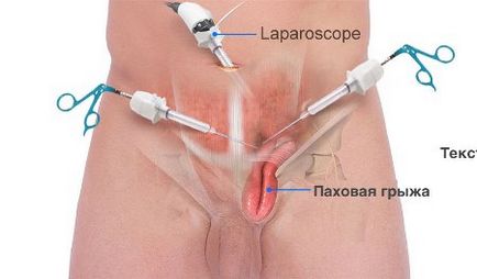 Lágyéksérv a férfiak és a működési költségek (vélemény)