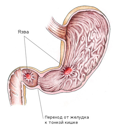 виразкова хвороба