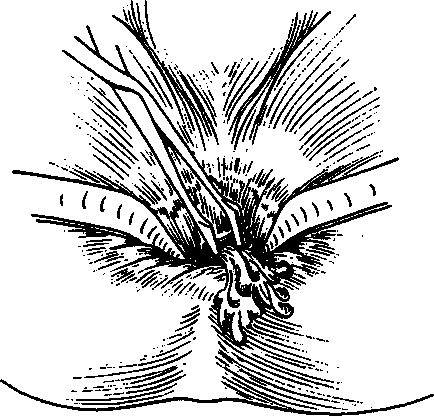 Abces perpendicular