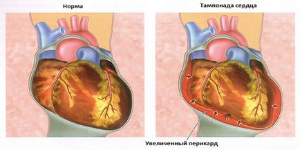 Перикардит серця що це таке, симптоми, причини і лікування