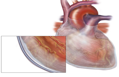Перикардит серця що це таке, симптоми, причини і лікування