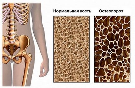 Храна за остеопороза при мъжете и жените диета, хранителни продукти