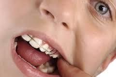 Vedd fogászati (fogra malocclusion) Vedd fogat