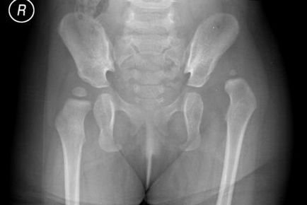 De ce există o hipoplazie a articulației șoldului la nou-născuți, osteopatul tău pe Internet