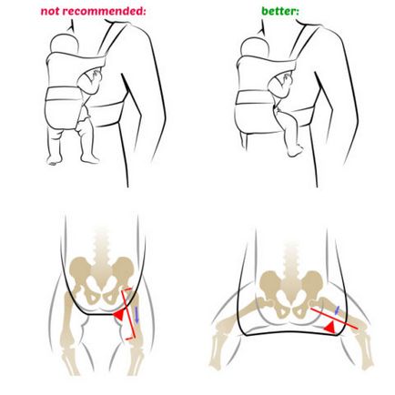 De ce există o hipoplazie a articulației șoldului la nou-născuți, osteopatul tău pe Internet