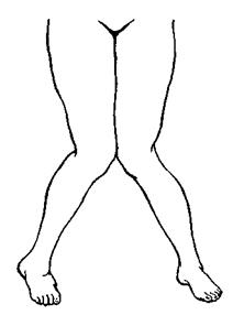 Підгинання патологічно зміненого колінного суглоба - колінний суглоб - ортопедична