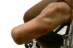 Показання до складного і атипового протезування гомілки і стегна