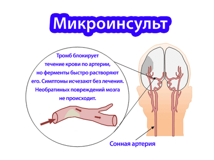 Efectele micro-accident vascular cerebral pentru femei și bărbați